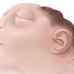 anencephaly