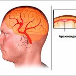 Brain arachnoiditis - what is it?