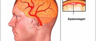 Brain arachnoiditis - what is it?