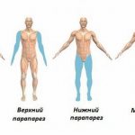 Монопарез это. Гемипарез тетрапарез. Монопарез парапарез. Центральный парапарез верхних конечностей. Гемипарез верхних конечностей.