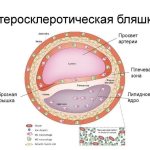 Бляшки в сосудах головного мозга
