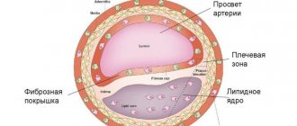 Plaques in the blood vessels of the brain