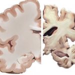 Alzheimer&#39;s disease