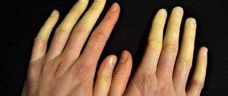 Raynaud's disease and traditional medicine (4)