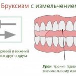 Bruxism with grinding is accompanied by creaking sounds