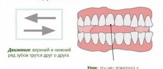 Бруксизм с измельчением сопровождается скрипящими звуками