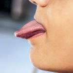 Bulbar syndrome - what is it?