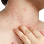 Are there symptoms of nerve-related allergies?