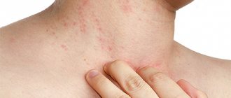Are there symptoms of nerve-related allergies?