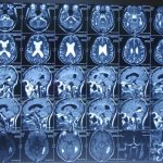 Cerebral angiography types