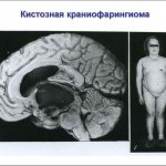 what is cerebral craniopharyngioma