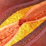 Diet for vascular atherosclerosis