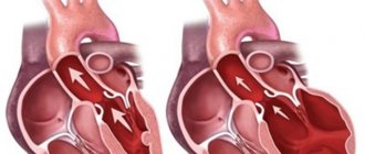 Left ventricular dilatation