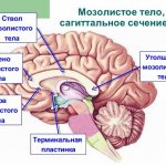 Dysgenesis of the corpus callosum in a child
