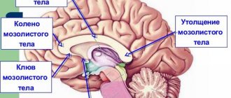 Dysgenesis of the corpus callosum in a child