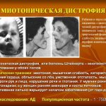 dystrophic myotonia Rossolimo Steinert Kurshman