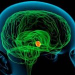 Доброкачественная опухоль головного мозга