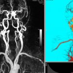 Доброкачественная опухоль головного мозга