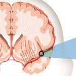 Effective drugs for stroke