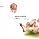 Эпилепсия