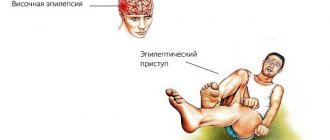 Эпилепсия
