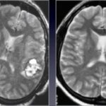 Brain hemangioma in adults: prognosis, symptoms