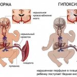 hypoxia during childbirth