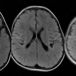 Глиоз головного мозга
