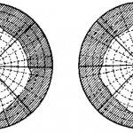 homonymous hemianopsia