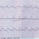 Myocardial infarction