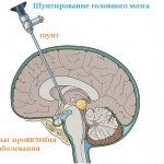 Sometimes the outflow of cerebrospinal fluid by installing a shunt is necessary for brain tumors that are accompanied by hypertension - increased intracranial pressure