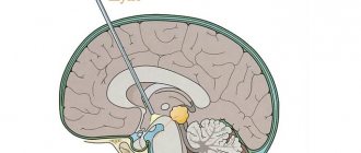 Sometimes the outflow of cerebrospinal fluid by installing a shunt is necessary for brain tumors that are accompanied by hypertension - increased intracranial pressure