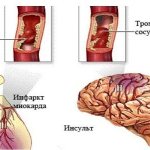 Stroke and heart attack