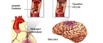Инсульт и инфаркт