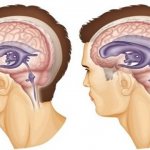 Избыточное скопление цереброспинальной жидкости в желудочковой системе головного мозга