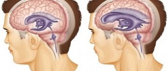 Избыточное скопление цереброспинальной жидкости в желудочковой системе головного мозга