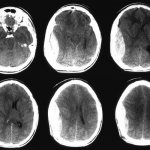 Pictures upon request MRI epidural hematoma