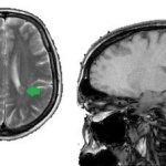 Латеровентрикулоасимметрия