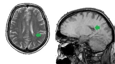 Асимметричное расширение боковых желудочков головного мозга. Асимметрия желудочков мозга. Расширение наружных ликворных пространств головного. Корональный срез головного мозга. Латеровентрикулоасимметрия головного такое.