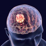 treatment of brain tumors in Europe