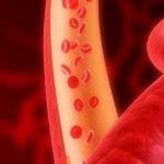 Лечение препаратами атеросклероза сосудов головного мозга