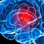 Менингиома головного мозга – причины, лечение опухоли, прогноз жизни