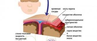 менингит