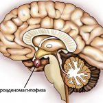 Pituitary microadenoma is extremely difficult to diagnose. Therefore, as a precaution, when examining the brain, attention should be paid to possible neoplasms in the gland. 