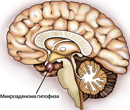 Микроаденома гипофиза: симптомы у женщин и мужчин, лечение, чем опасна