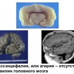 Brain with agyria