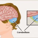 cerebellar infection