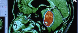 MRI of the brain