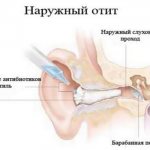 Наружный отит