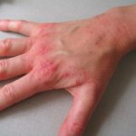 Нейродермит